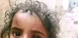 عنف أسري متصاعد .. طفلة تتعرض للتعذيب في تعز