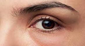 ما الذي تخفيه انتفاخات تحت العين عن صحتك؟