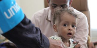 اليونيسف: نصف أطفال اليمن دون الخامسة يعانون من سوء التغذية الحاد