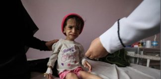 “كتلة التغذية” تناشد الحصول على 91 مليون دولار لعلاج سوء التغذية لدى الأطفال والنساء في اليمن