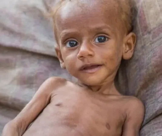 ارتفاع حاد في سوء تغذية الأطفال باليمن وسط تفاقم الأزمة الإنسانية