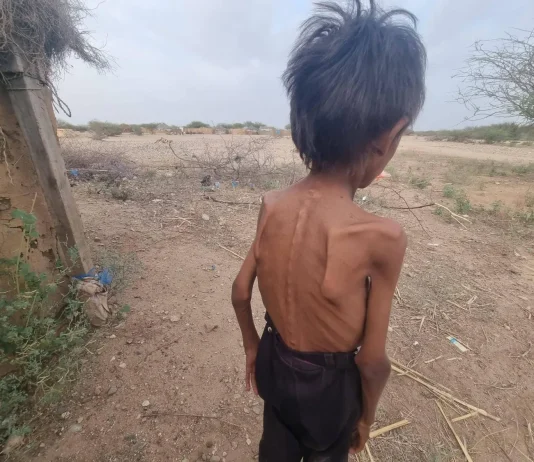 الجوع ينهش اليمن… والحوثيون يستخفون بالمأساة
